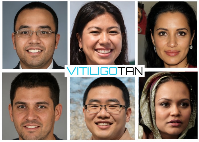 Best Vitiligo Make-up For Medium Skin