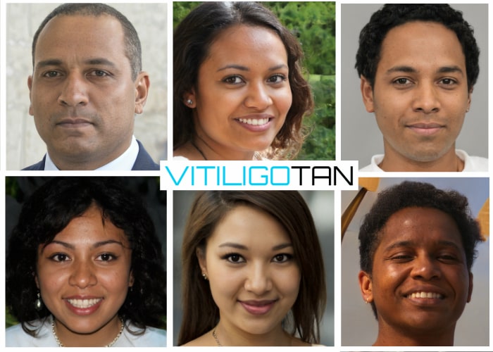 Best Vitiligo Makup